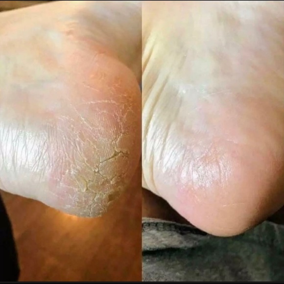(1) Epoch Foot Treatment Sole solution - Picture 3 of 8